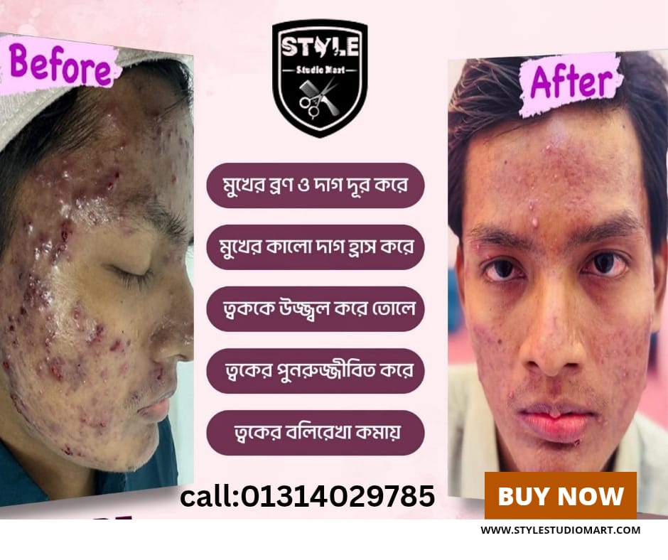 Acne   Remove   (Laser Treatment)